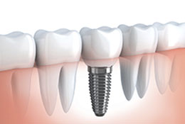 Dental Implants, Winnipeg Dentist
