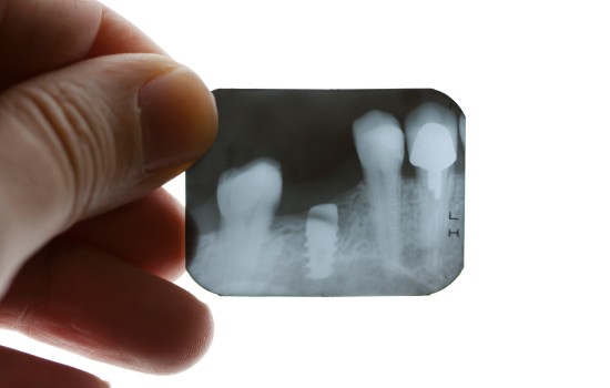 Dental X-Rays, Winnipeg Dentist
