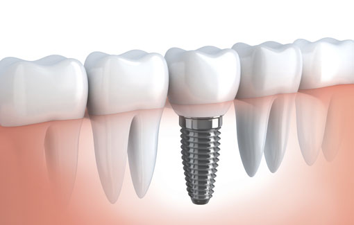 Implants, Downtown Dental, Winnipeg